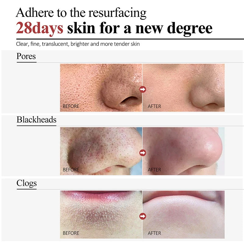 Salicylic Acid Skin tightening Cream