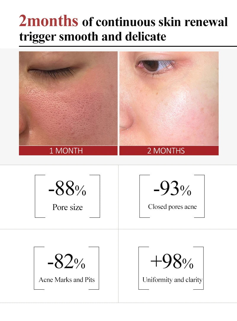 Salicylic Acid Skin tightening Cream