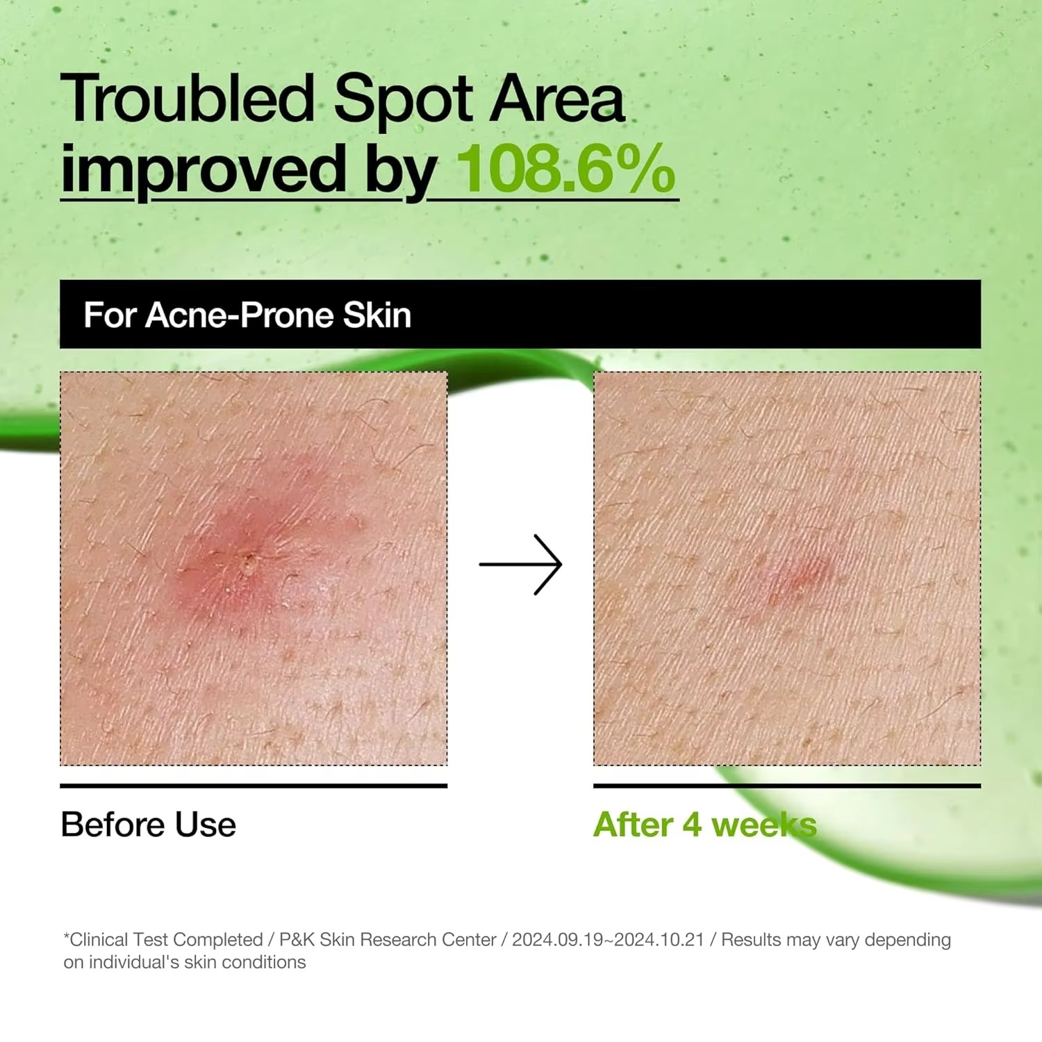 Anua Azelaic  Korean Skincare serum for Sensitive Skin