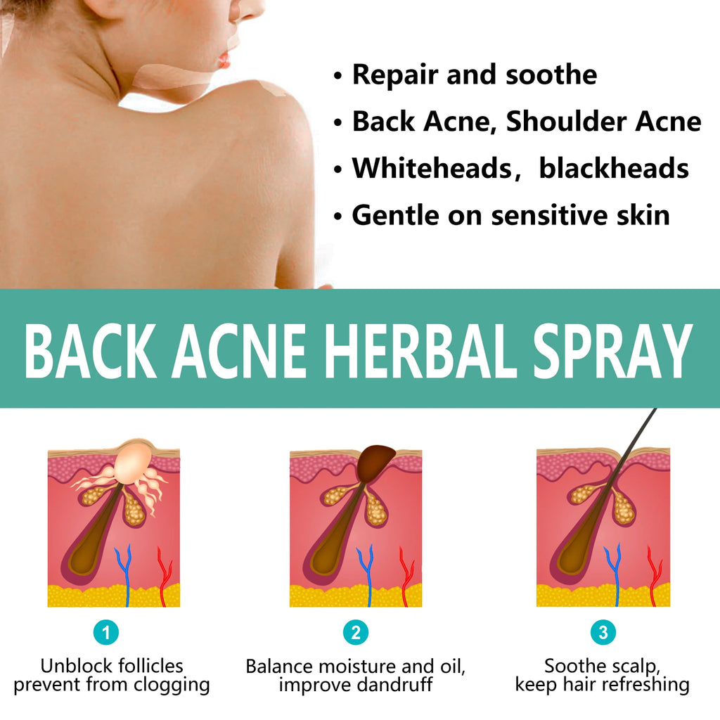 Herbal Acne back spray