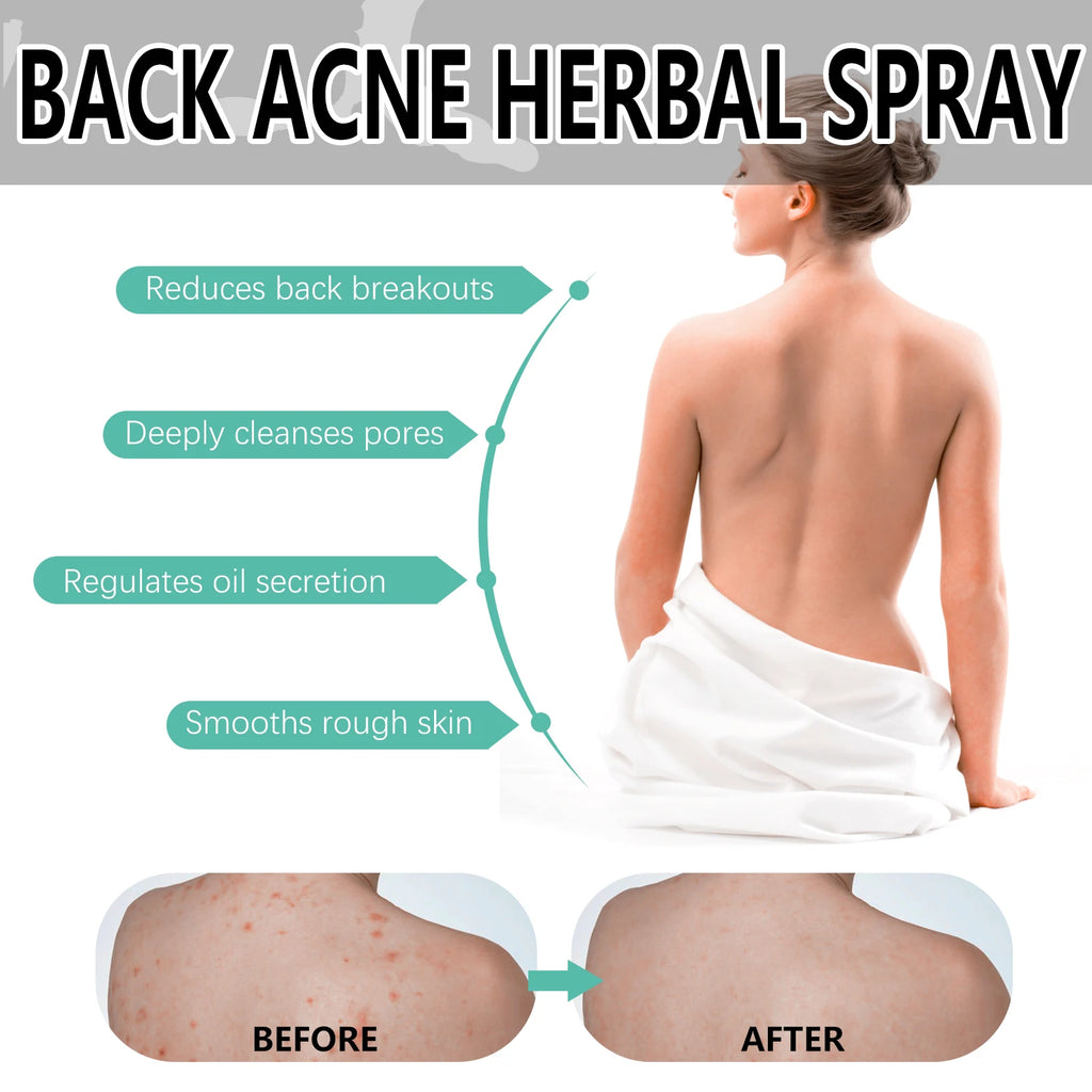 Herbal Acne back spray