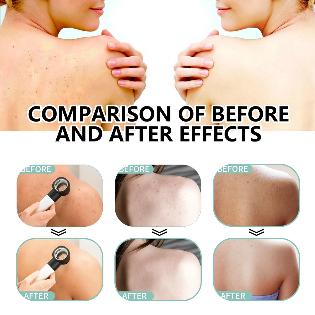 Herbal Acne back spray
