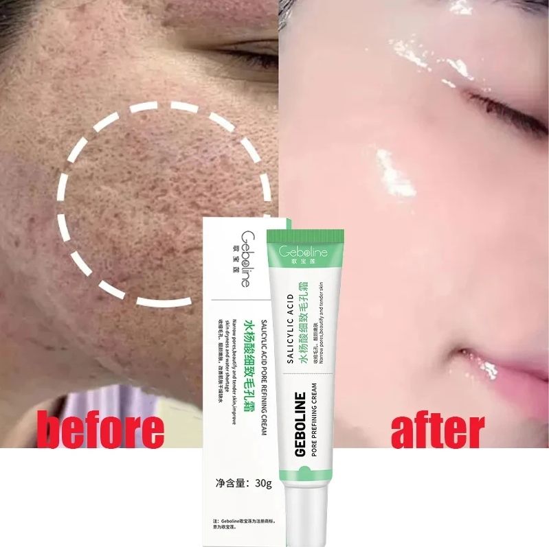 Salicylic Acid Skin tightening Cream