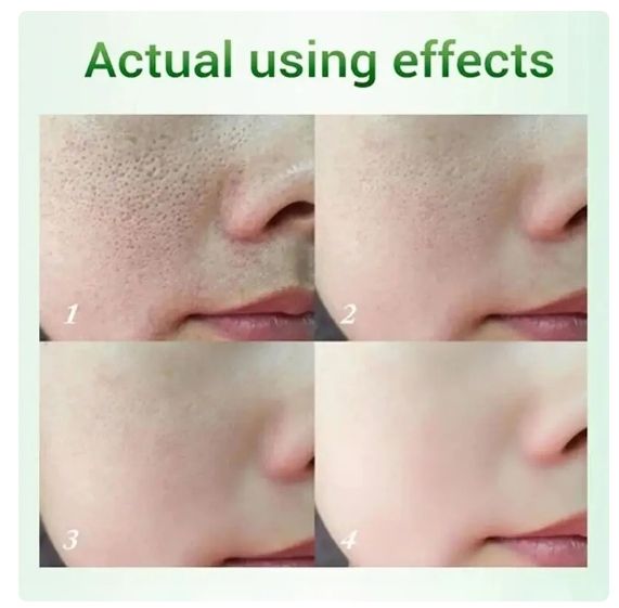 Salicylic Acid Skin tightening Cream